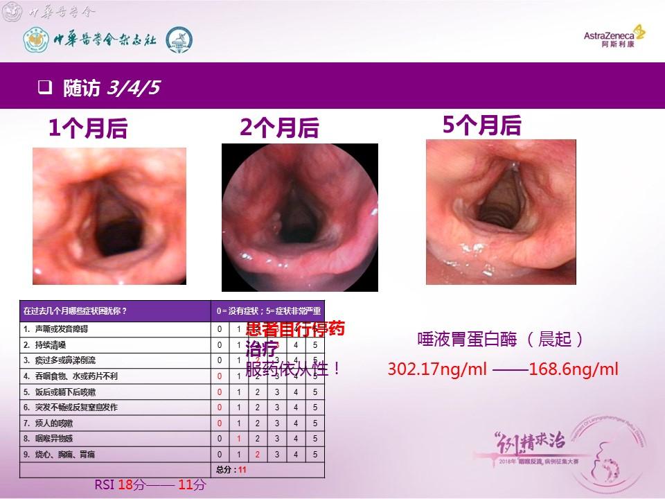 二等奖 1例咽喉反流所致喉接触性肉芽肿的诊治体会