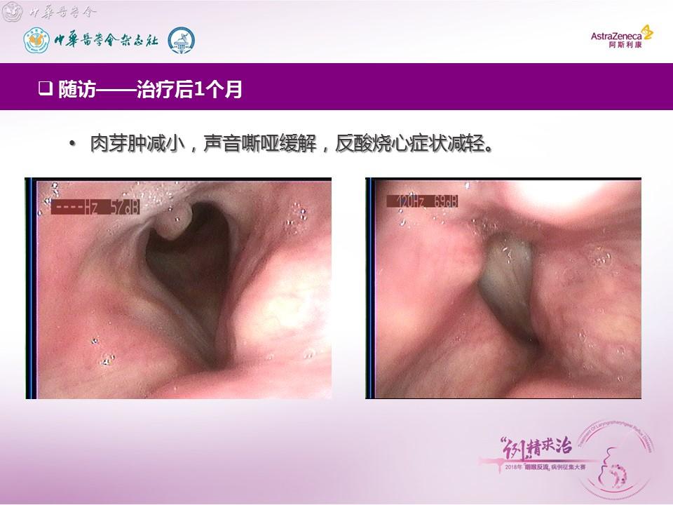 三等奖 合并重度食管动力障碍的声带后连合肉芽肿