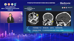 经鼻内镜柯陆氏入路辅助鼻咽纤维血管瘤切除手术一例