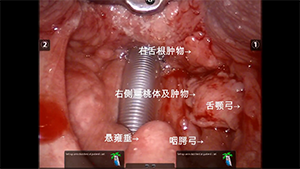 经口机器人手术治疗口咽癌的初步经验