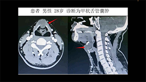 无充气颏下全腔镜甲状舌管囊肿切除术临床分析